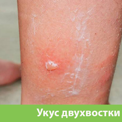 Укус двухвостки в Давлеканово