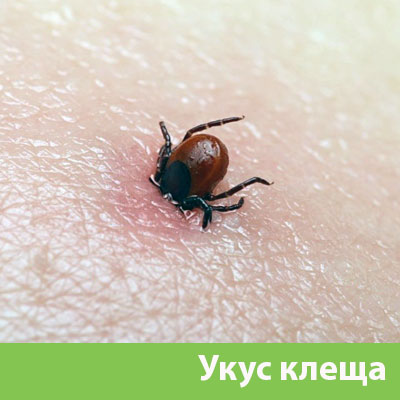 Укус клеща в Давлеканово