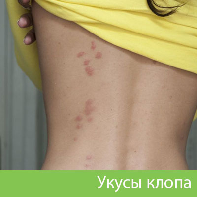 Профессиональное уничтожение клопов в Давлеканово
